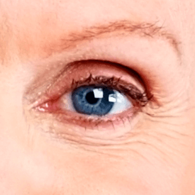 Macular Degeneration
